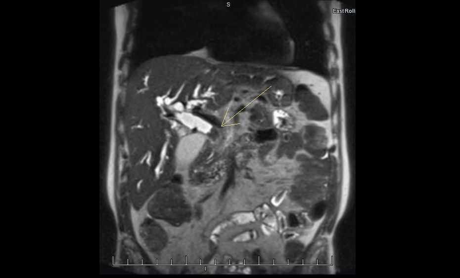 MRI showing bile duct tumor